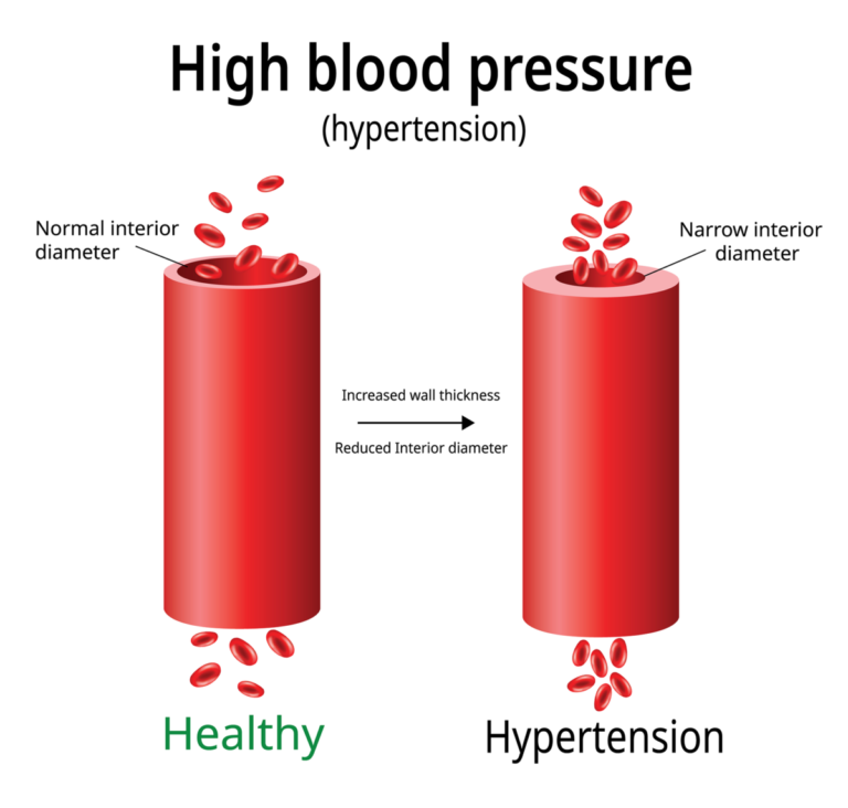 high-blood-pressure-hypertension-1200x1143